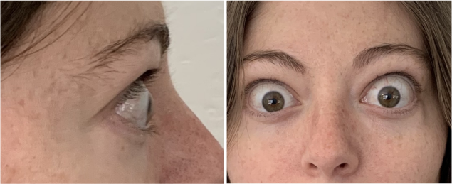 PatientResults_Slider03_Patient_01_Infusion01