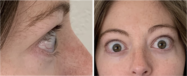 PatientResults_Slider03_Patient_01_Infusion02