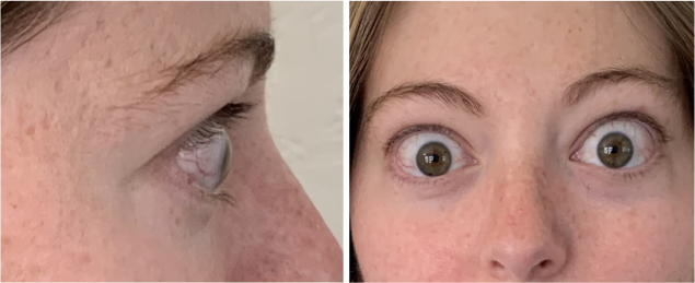 PatientResults_Slider03_Patient_01_Infusion03